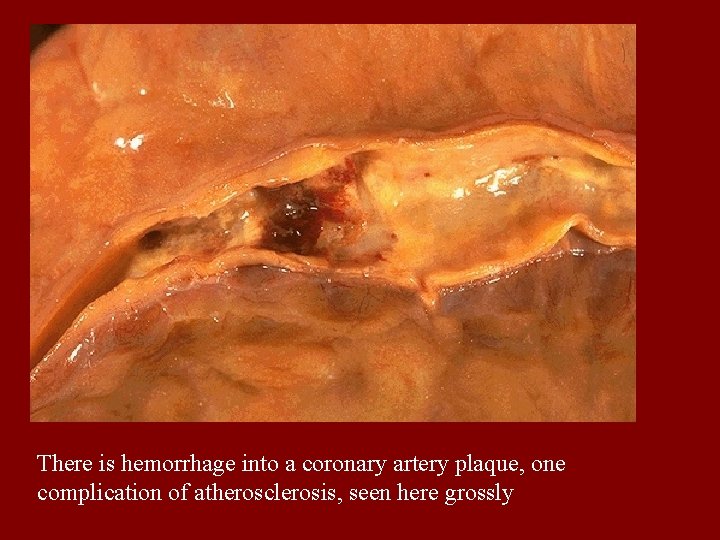 There is hemorrhage into a coronary artery plaque, one complication of atherosclerosis, seen here