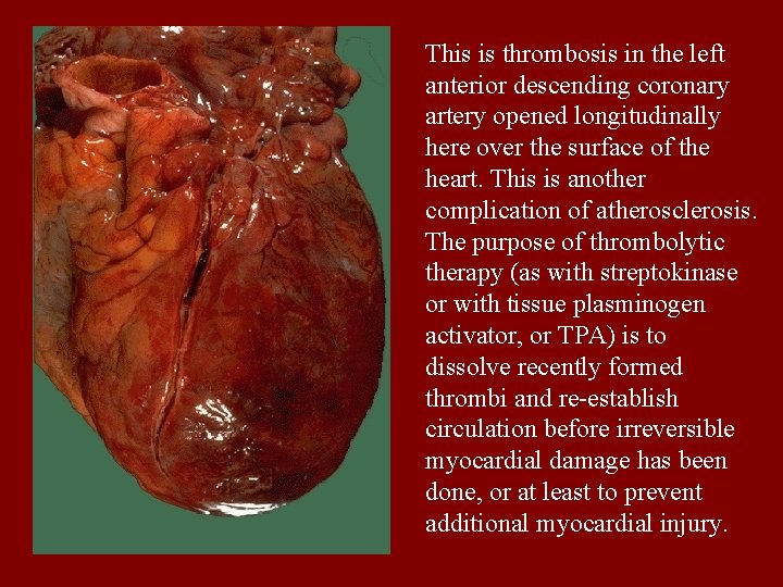 This is thrombosis in the left anterior descending coronary artery opened longitudinally here over