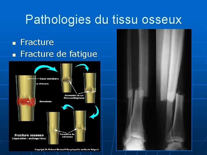 Pathologies du tissu osseux n n Fracture de fatigue 