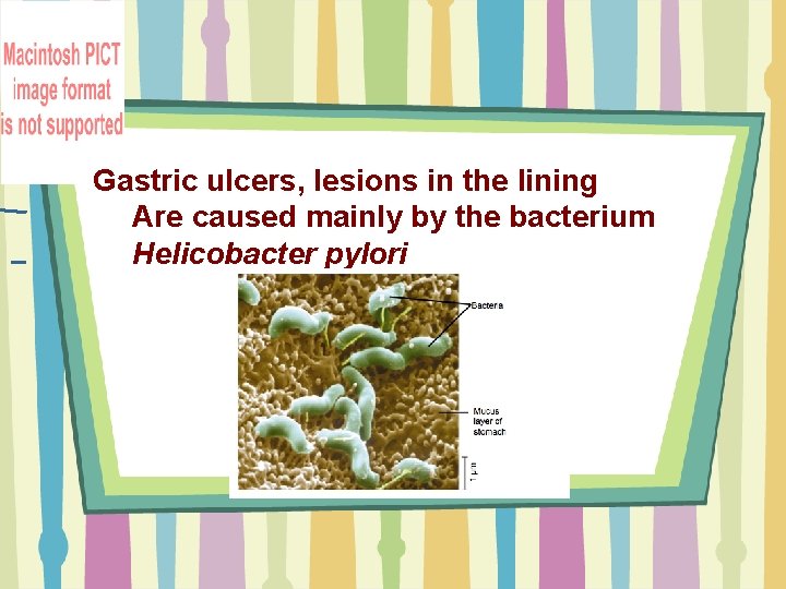 Gastric ulcers, lesions in the lining Are caused mainly by the bacterium Helicobacter pylori