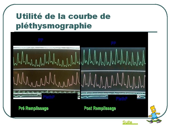 Utilité de la courbe de pléthysmographie Suite…. 