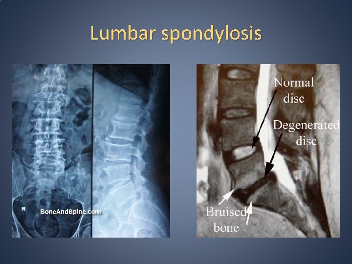 Lumbar spondylosis 
