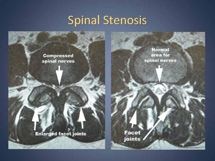 Spinal Stenosis 