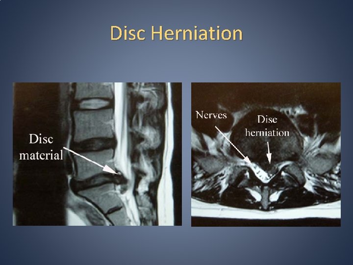 Disc Herniation 