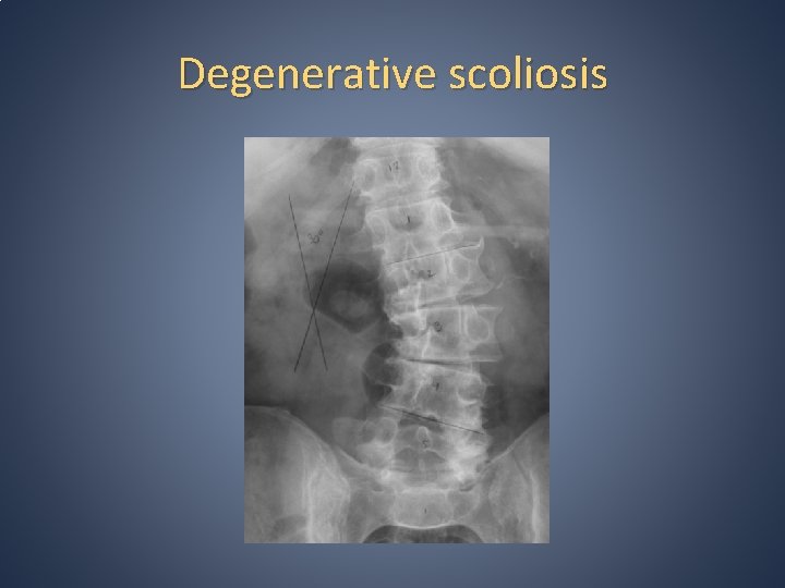 Degenerative scoliosis 