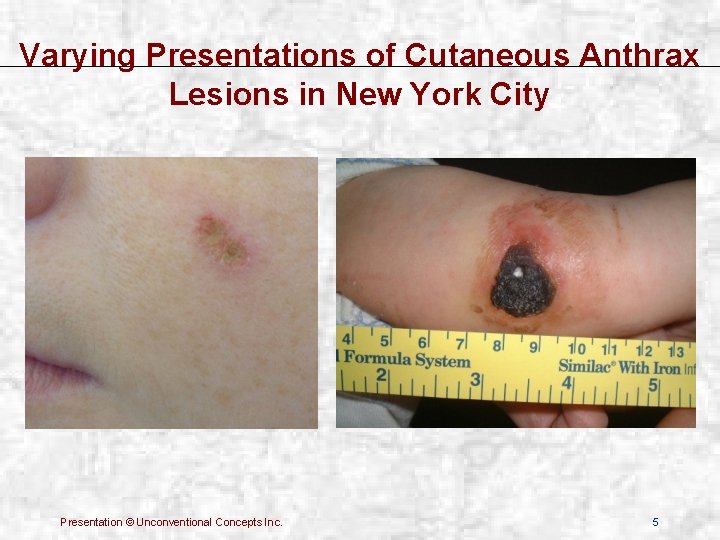 Varying Presentations of Cutaneous Anthrax Lesions in New York City Presentation © Unconventional Concepts