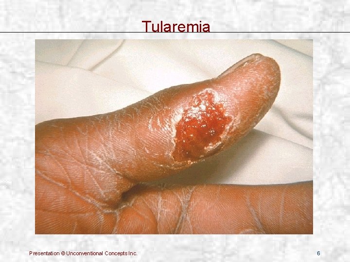 Tularemia Presentation © Unconventional Concepts Inc. 6 