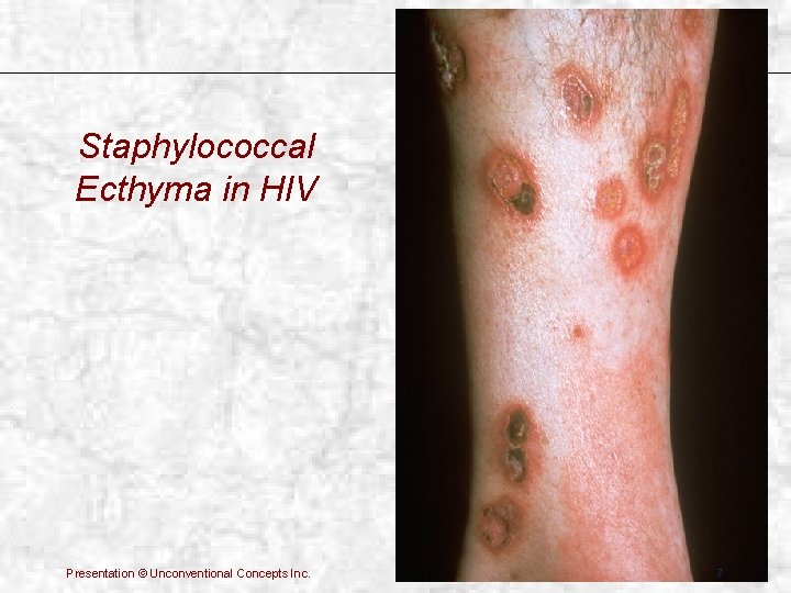 Staphylococcal Ecthyma in HIV Presentation © Unconventional Concepts Inc. 7 