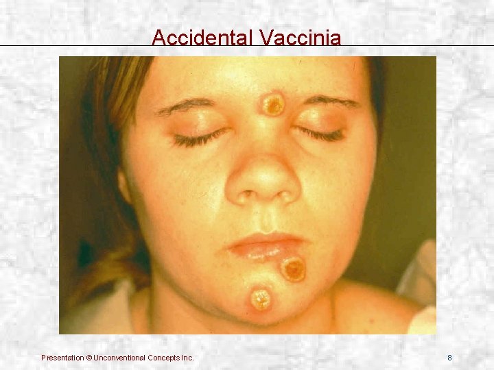 Accidental Vaccinia Presentation © Unconventional Concepts Inc. 8 