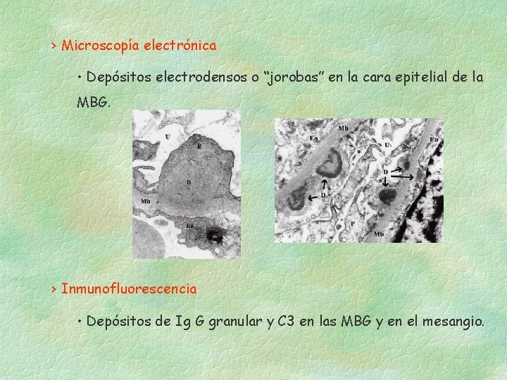 › Microscopía electrónica • Depósitos electrodensos o “jorobas” en la cara epitelial de la