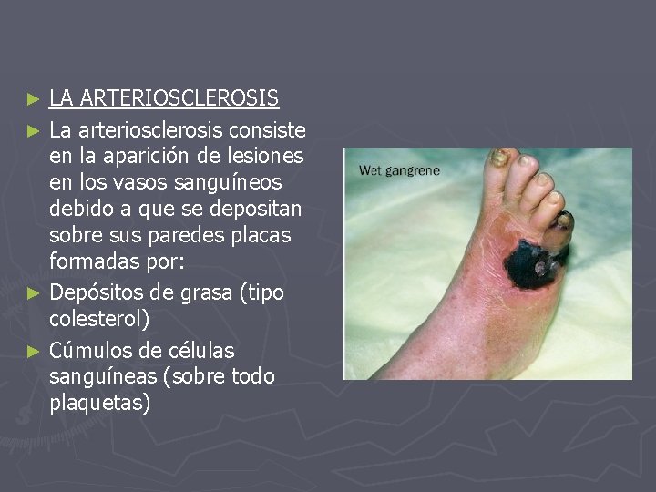 LA ARTERIOSCLEROSIS ► La arteriosclerosis consiste en la aparición de lesiones en los vasos