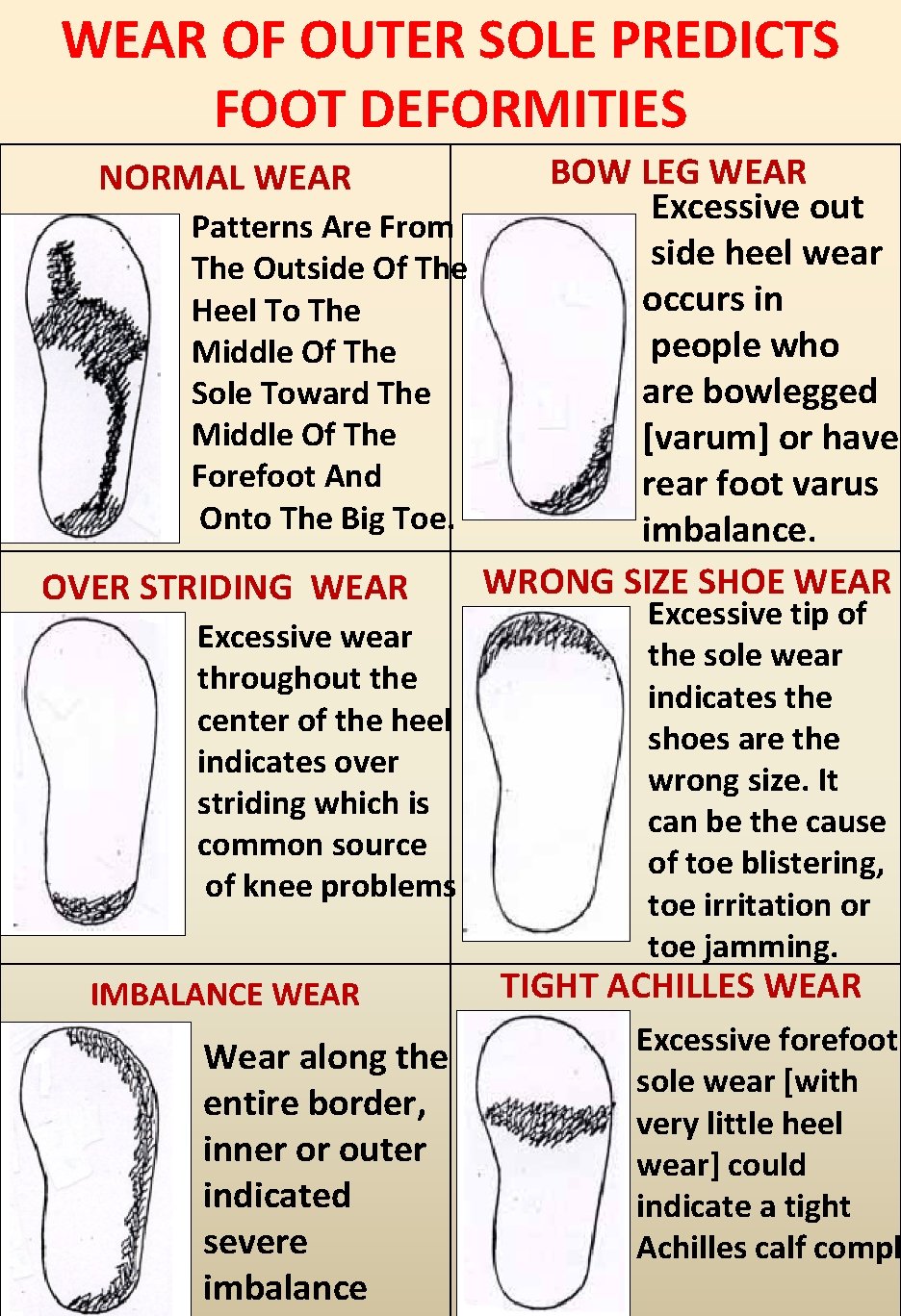 WEAR OF OUTER SOLE PREDICTS FOOT DEFORMITIES BOW LEG WEAR Excessive out Patterns Are