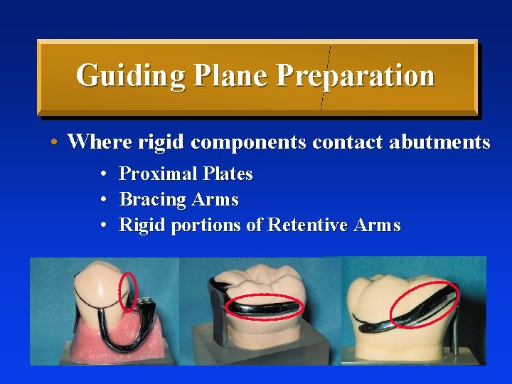 Guiding Plane Preparation • Where rigid components contact abutments • Proximal Plates • Bracing