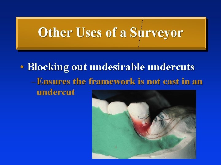 Other Uses of a Surveyor • Blocking out undesirable undercuts – Ensures the framework