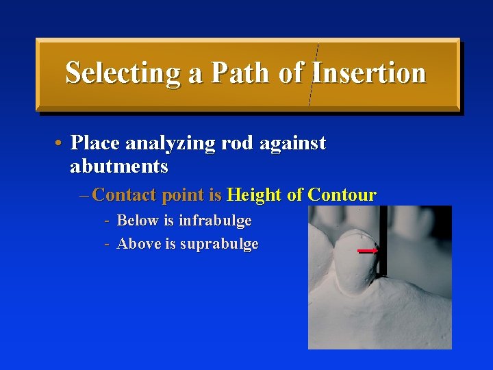 Selecting a Path of Insertion • Place analyzing rod against abutments – Contact point