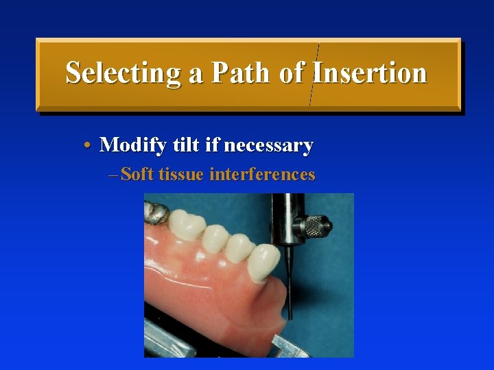 Selecting a Path of Insertion • Modify tilt if necessary – Soft tissue interferences