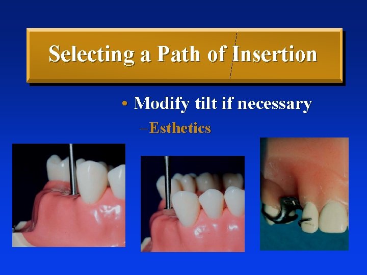 Selecting a Path of Insertion • Modify tilt if necessary – Esthetics 