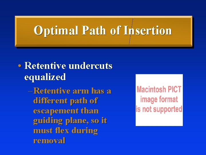 Optimal Path of Insertion • Retentive undercuts equalized – Retentive arm has a different