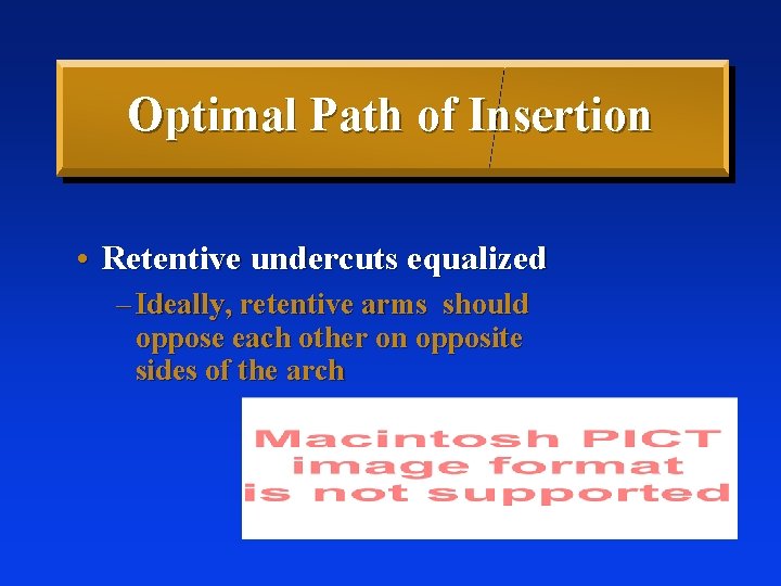 Optimal Path of Insertion • Retentive undercuts equalized – Ideally, retentive arms should oppose