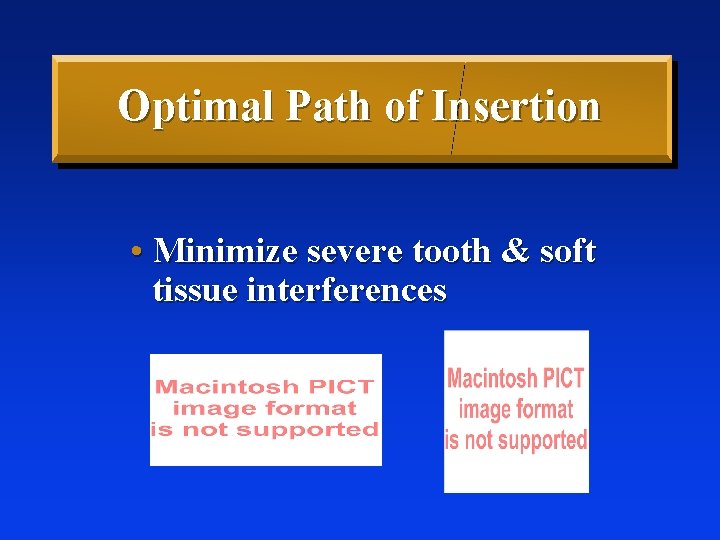 Optimal Path of Insertion • Minimize severe tooth & soft tissue interferences 