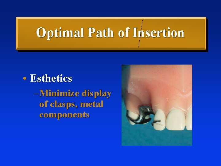 Optimal Path of Insertion • Esthetics – Minimize display of clasps, metal components 