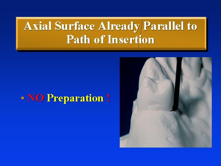 Axial Surface Already Parallel to Path of Insertion • NO Preparation ! 