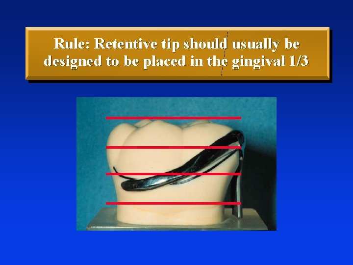 Rule: Retentive tip should usually be designed to be placed in the gingival 1/3