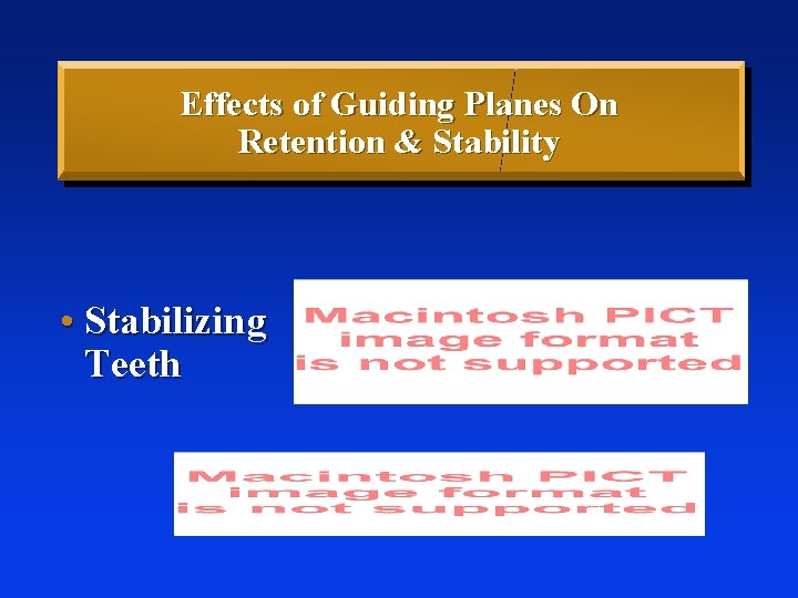 Effects of Guiding Planes On Retention & Stability • Stabilizing Teeth 