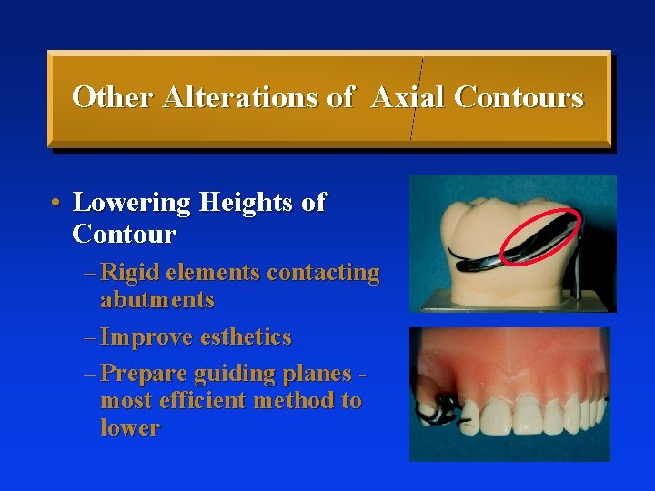 Other Alterations of Axial Contours • Lowering Heights of Contour – Rigid elements contacting