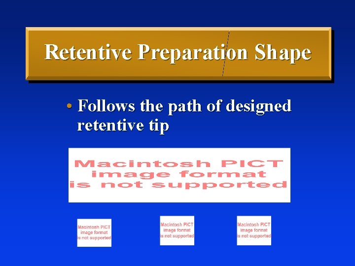 Retentive Preparation Shape • Follows the path of designed retentive tip 