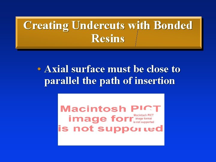 Creating Undercuts with Bonded Resins • Axial surface must be close to parallel the