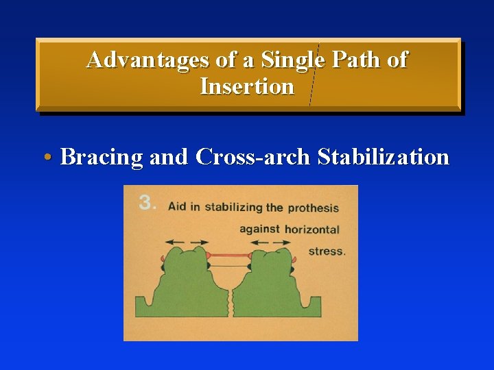 Advantages of a Single Path of Insertion • Bracing and Cross-arch Stabilization 