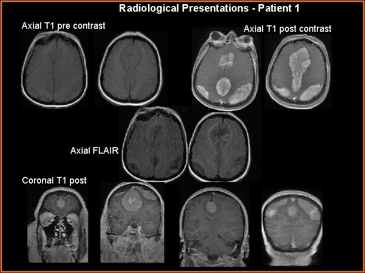 Radiological Presentations - Patient 1 Axial T 1 pre contrast Axial FLAIR Coronal T