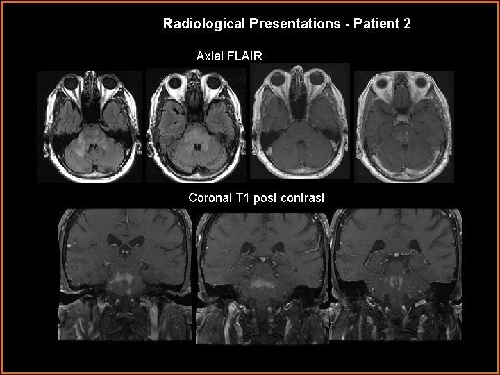 Radiological Presentations - Patient 2 Axial FLAIR Coronal T 1 post contrast 