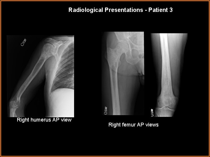 Radiological Presentations - Patient 3 Right humerus AP view Right femur AP views 