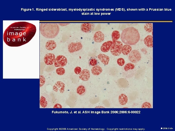 Figure 1. Ringed sideroblast, myelodysplastic syndromes (MDS), shown with a Prussian blue stain at