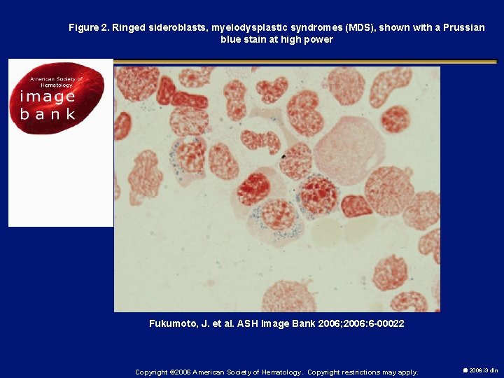 Figure 2. Ringed sideroblasts, myelodysplastic syndromes (MDS), shown with a Prussian blue stain at