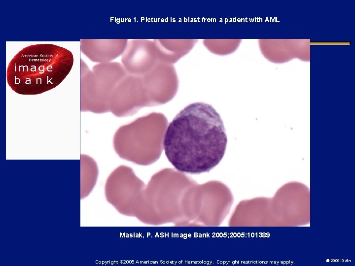 Figure 1. Pictured is a blast from a patient with AML Maslak, P. ASH