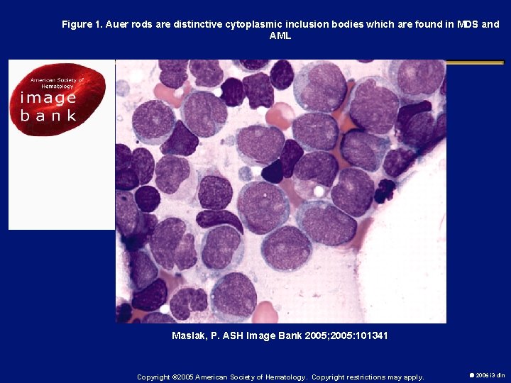 Figure 1. Auer rods are distinctive cytoplasmic inclusion bodies which are found in MDS