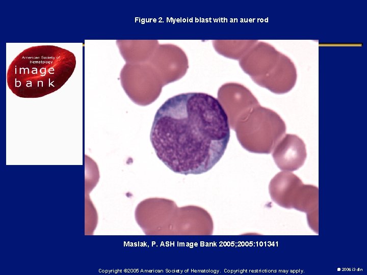 Figure 2. Myeloid blast with an auer rod Maslak, P. ASH Image Bank 2005;