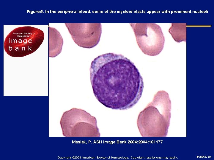 Figure 5. In the peripheral blood, some of the myeloid blasts appear with prominent