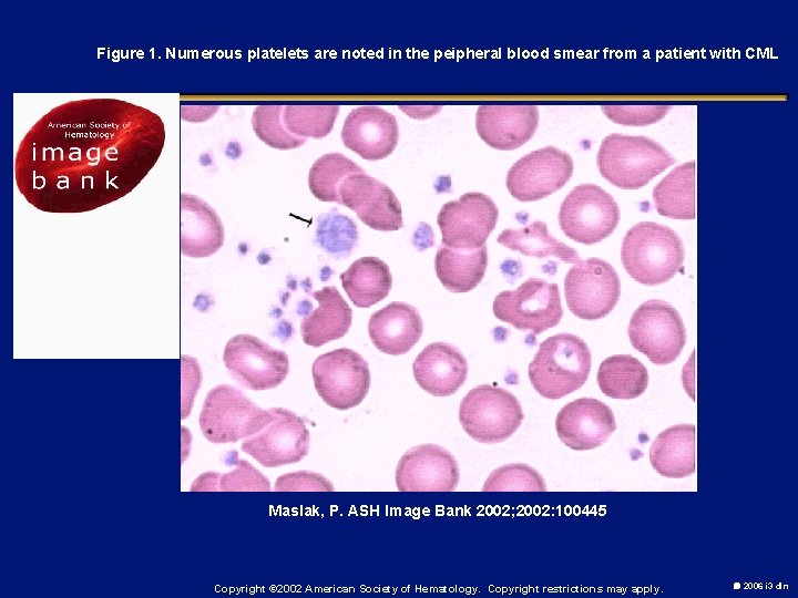 Figure 1. Numerous platelets are noted in the peipheral blood smear from a patient