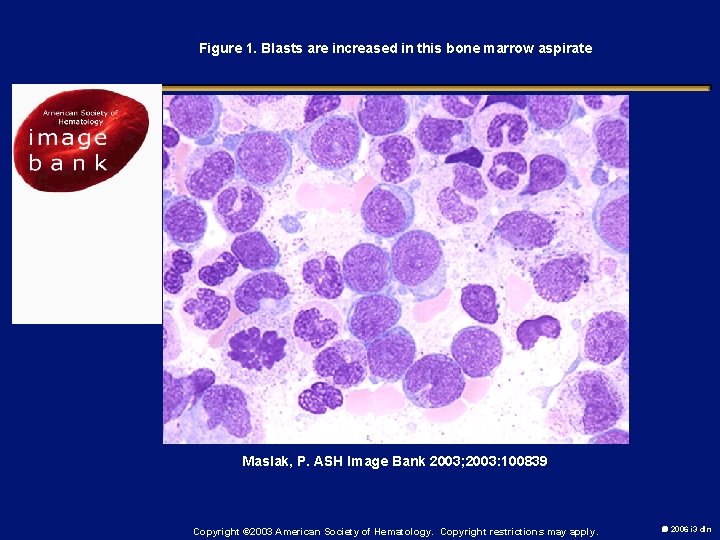 Figure 1. Blasts are increased in this bone marrow aspirate Maslak, P. ASH Image