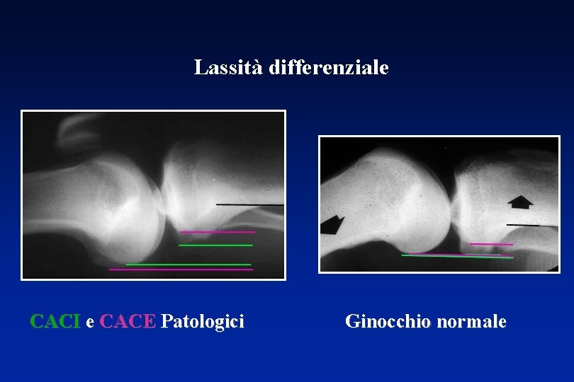 Lassità differenziale CACI e CACE Patologici Ginocchio normale 