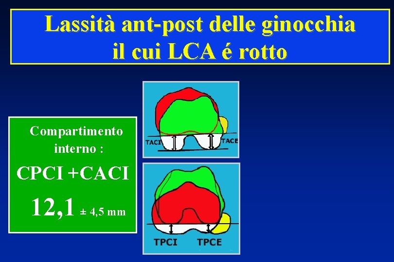 Lassità ant-post delle ginocchia il cui LCA é rotto Compartimento interno : CPCI +CACI