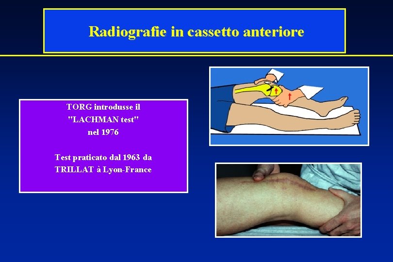 Radiografie in cassetto anteriore TORG introdusse il "LACHMAN test" nel 1976 Test praticato dal