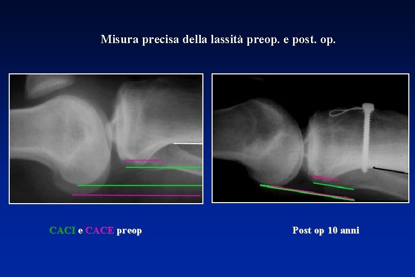 Misura precisa della lassità preop. e post. op. CACI e CACE preop Post op