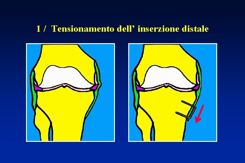 1 / Tensionamento dell’ inserzione distale 