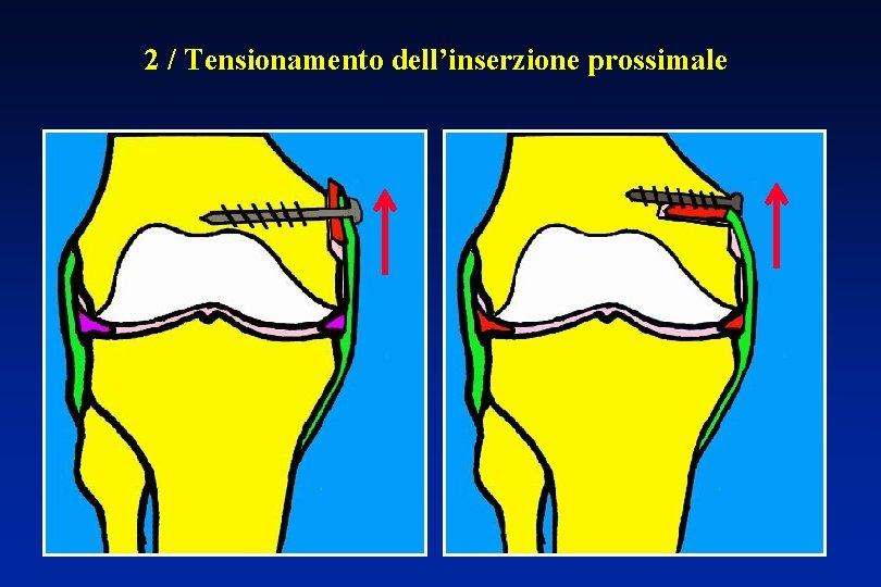 2 / Tensionamento dell’inserzione prossimale 