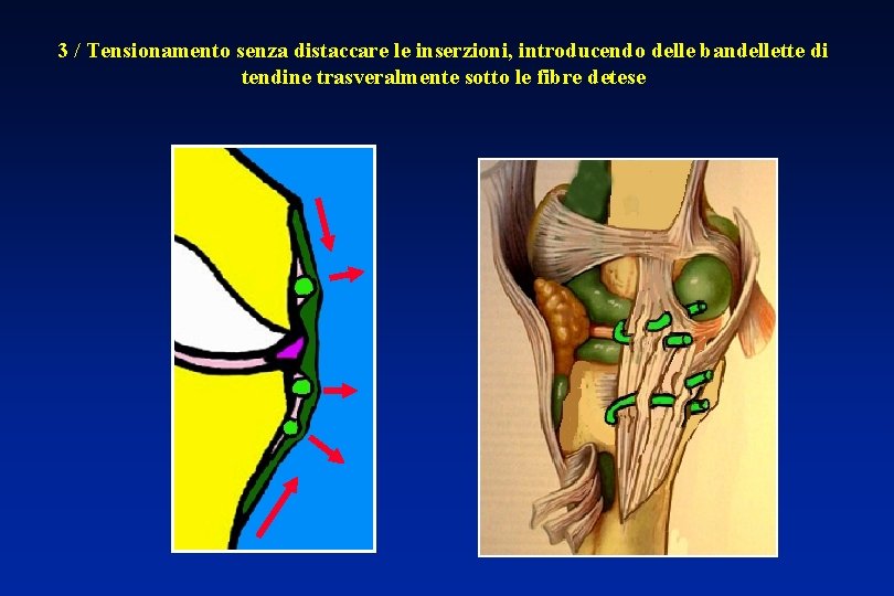 3 / Tensionamento senza distaccare le inserzioni, introducendo delle bandellette di tendine trasveralmente sotto